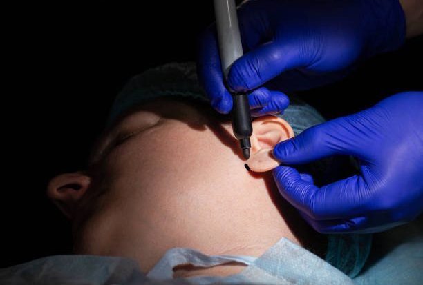 Plastic surgery to change the asymmetry of the ears and earlobe defects. Aesthetic otoplasty